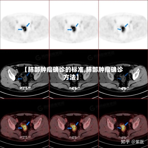 【肺部肿瘤确诊的标准,肺部肿瘤确诊方法】