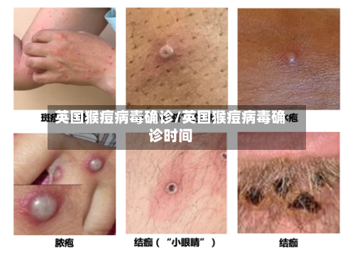 英国猴痘病毒确诊/英国猴痘病毒确诊时间