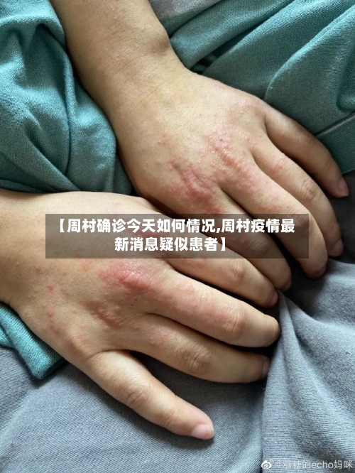 【周村确诊今天如何情况,周村疫情最新消息疑似患者】