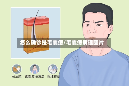 怎么确诊是毛囊痣/毛囊痣病理图片