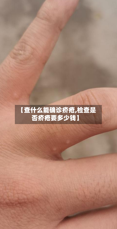 【查什么能确诊疥疮,检查是否疥疮要多少钱】