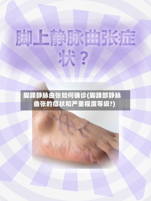 脚踝静脉曲张如何确诊(脚踝部静脉曲张的症状和严重程度等级?)