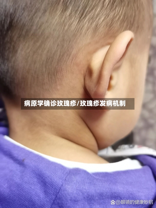 病原学确诊玫瑰疹/玫瑰疹发病机制