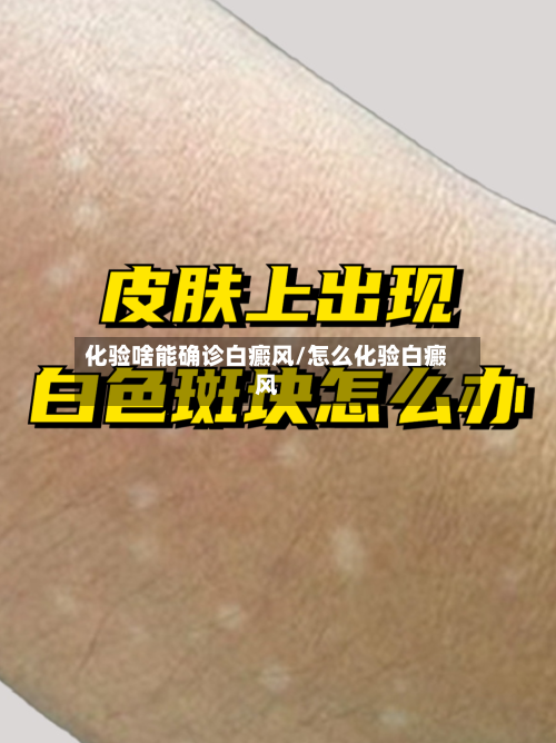 化验啥能确诊白癜风/怎么化验白癜风