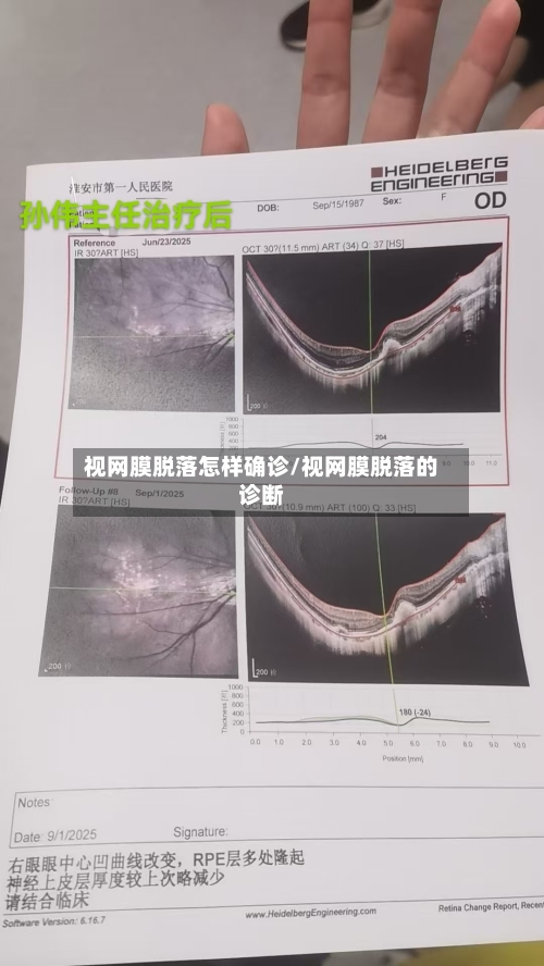 视网膜脱落怎样确诊/视网膜脱落的诊断