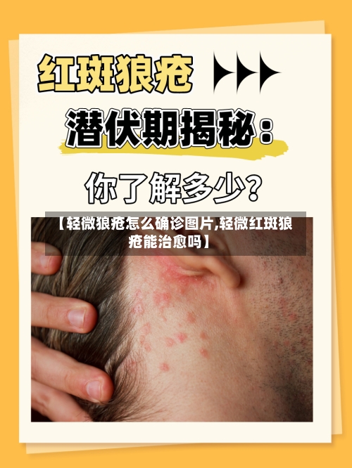 【轻微狼疮怎么确诊图片,轻微红斑狼疮能治愈吗】