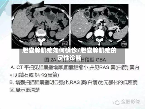胆囊腺肌症如何确诊/胆囊腺肌症的定性诊断