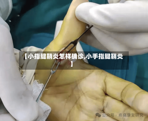 【小指腱鞘炎怎样确诊,小手指腱鞘炎】
