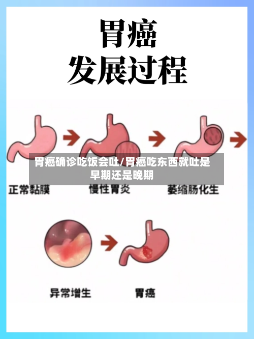 胃癌确诊吃饭会吐/胃癌吃东西就吐是早期还是晚期