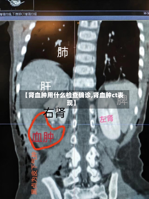 【肾血肿用什么检查确诊,肾血肿ct表现】