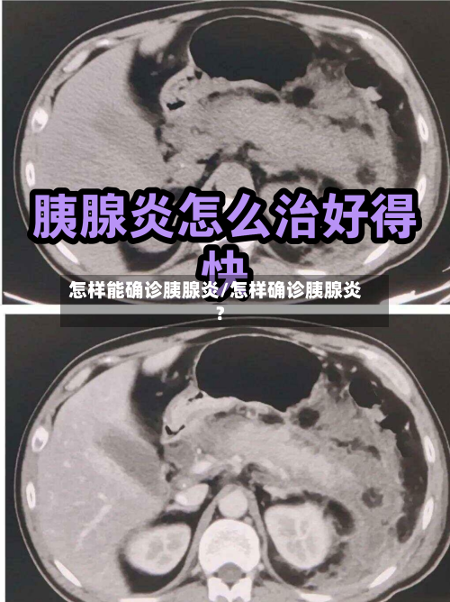 怎样能确诊胰腺炎/怎样确诊胰腺炎?