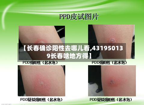 【长春确诊阳性去哪儿看,431950139长春啥地方得】