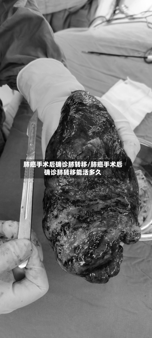 肺癌手术后确诊肺转移/肺癌手术后确诊肺转移能活多久