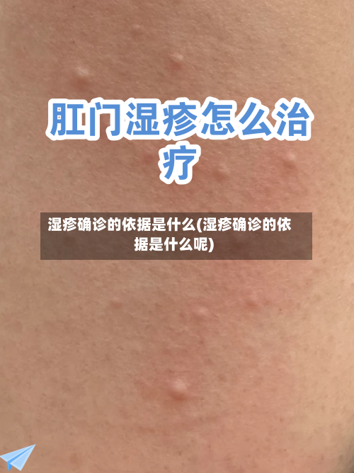 湿疹确诊的依据是什么(湿疹确诊的依据是什么呢)
