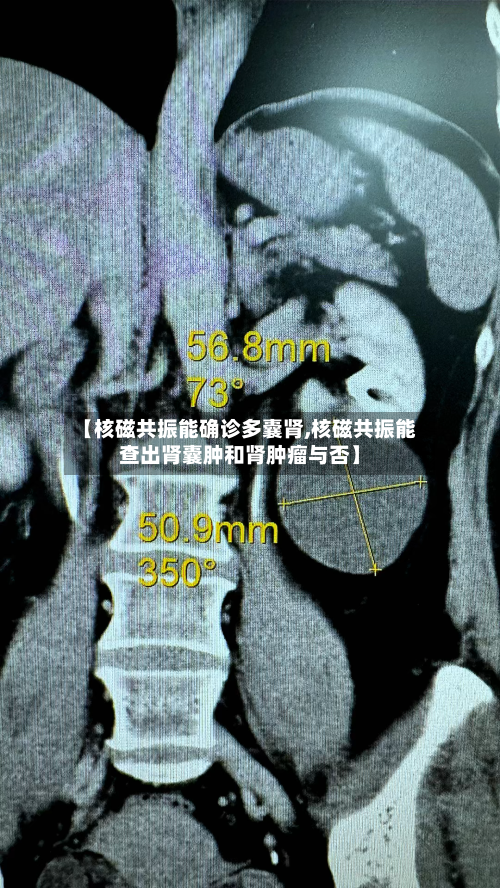 【核磁共振能确诊多囊肾,核磁共振能查出肾囊肿和肾肿瘤与否】