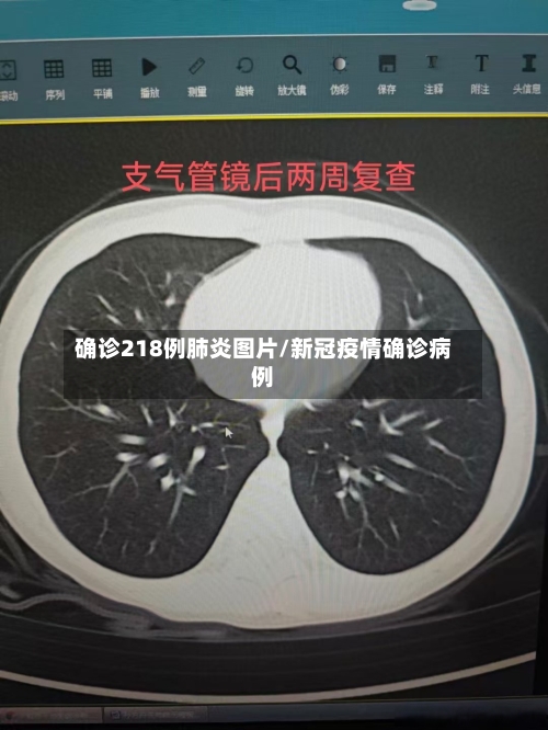 确诊218例肺炎图片/新冠疫情确诊病例