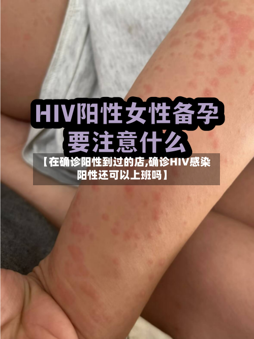 【在确诊阳性到过的店,确诊HIV感染阳性还可以上班吗】